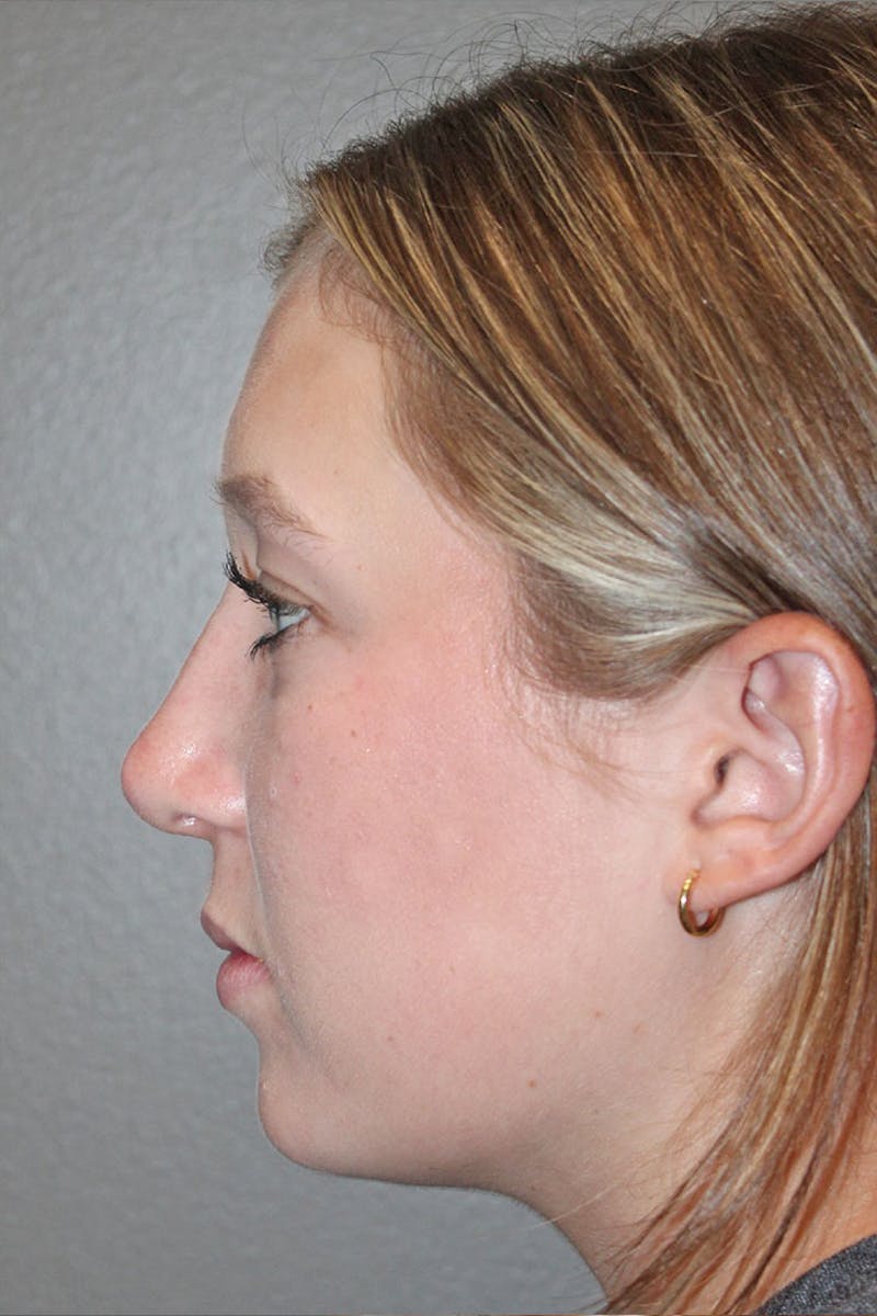 Rhinoplasty Before & After Gallery - Patient 146669558 - Image 6