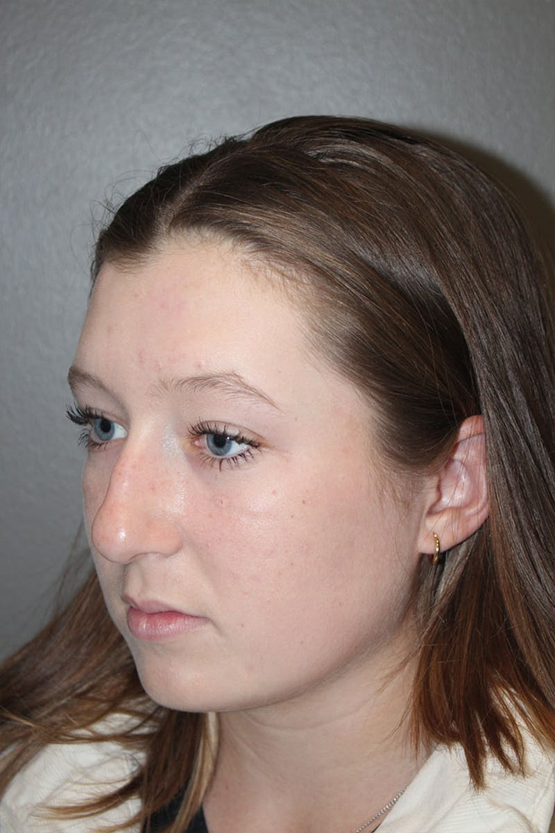 Rhinoplasty Before & After Gallery - Patient 146669558 - Image 7