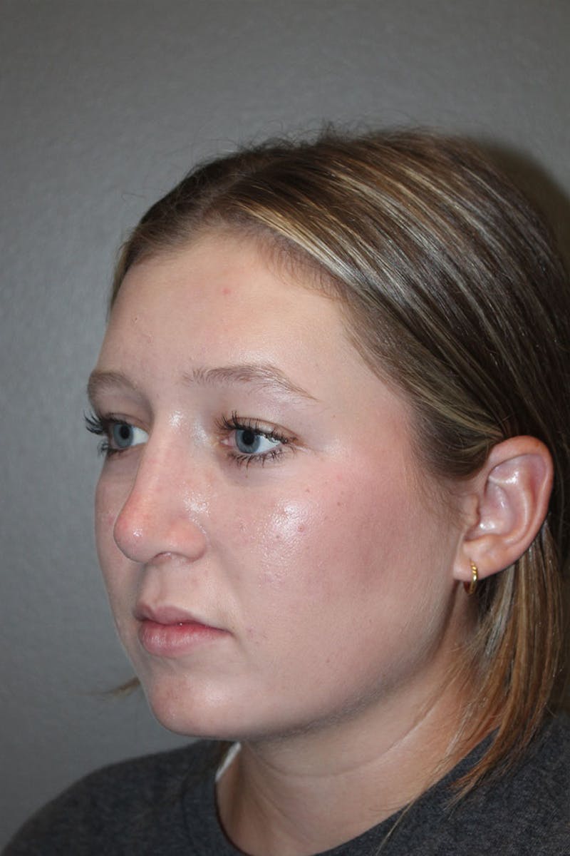 Rhinoplasty Before & After Gallery - Patient 146669558 - Image 8