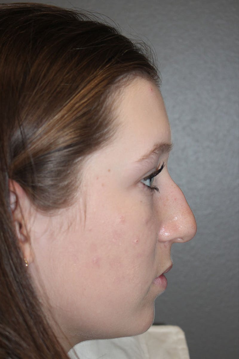 Rhinoplasty Before & After Gallery - Patient 146669558 - Image 1