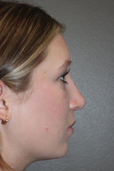 Rhinoplasty Before & After Gallery - Patient 146669558 - Image 2