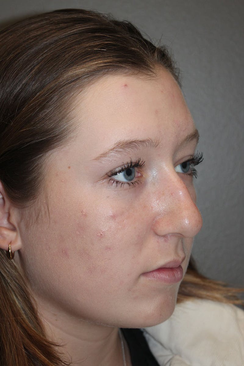 Rhinoplasty Before & After Gallery - Patient 146669558 - Image 9