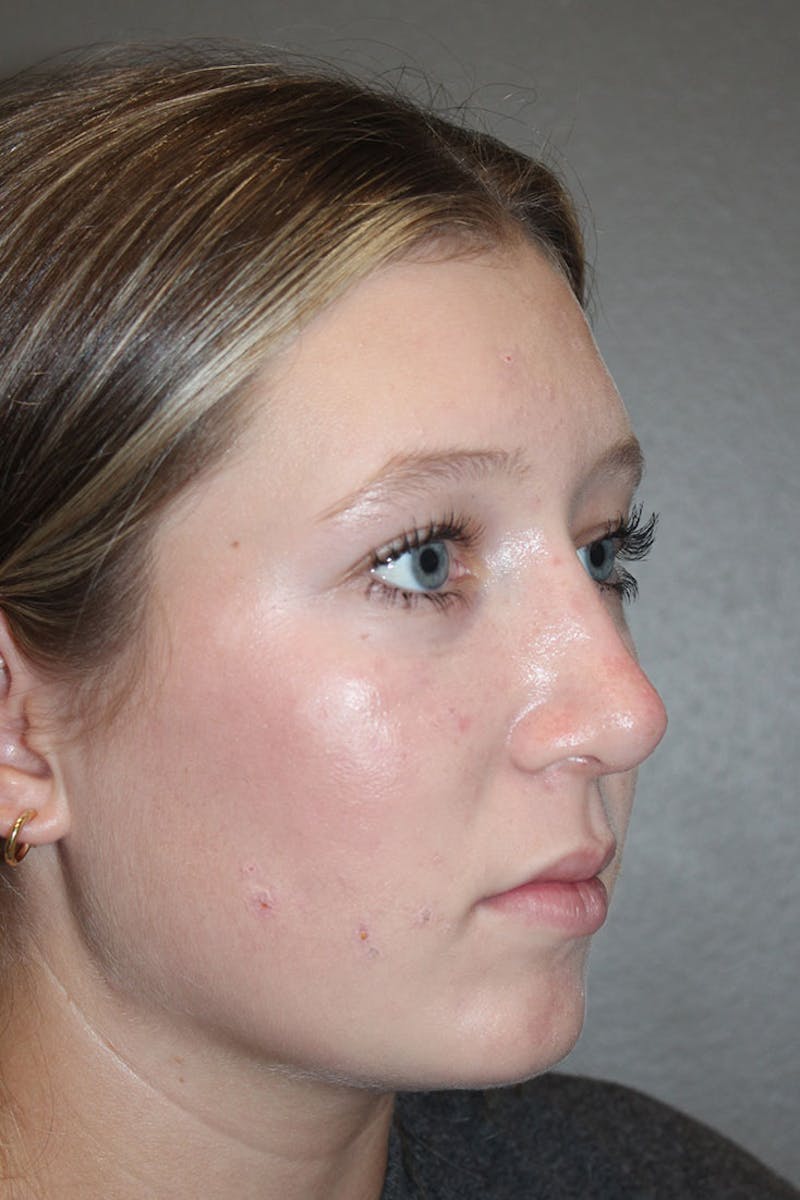 Rhinoplasty Before & After Gallery - Patient 146669558 - Image 10