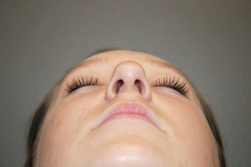 Rhinoplasty Before & After Gallery - Patient 146669558 - Image 11