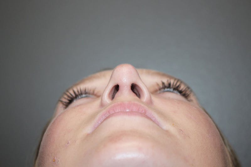 Rhinoplasty Before & After Gallery - Patient 146669558 - Image 12