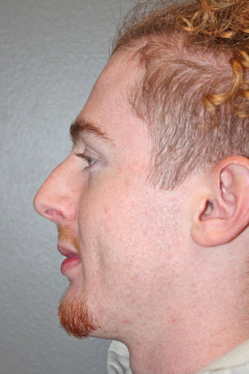 Rhinoplasty Before & After Gallery - Patient 146669557 - Image 7