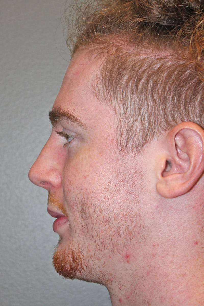 Rhinoplasty Before & After Gallery - Patient 146669557 - Image 8