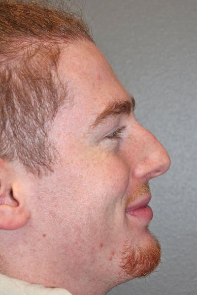 Rhinoplasty Before & After Gallery - Patient 146669557 - Image 1