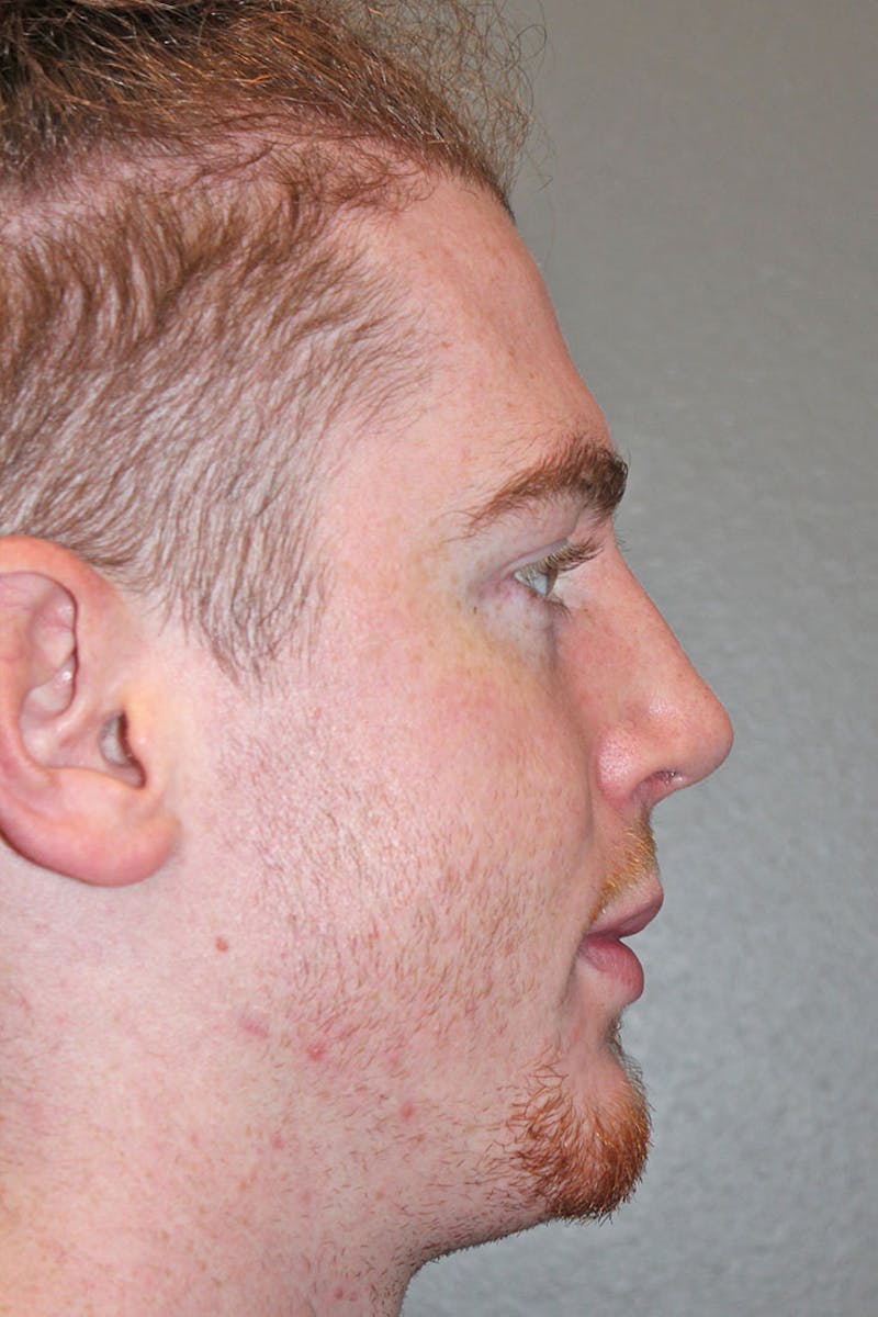 Rhinoplasty Before & After Gallery - Patient 146669557 - Image 2
