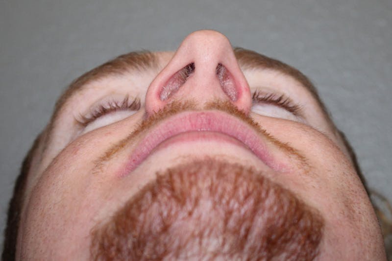 Rhinoplasty Before & After Gallery - Patient 146669557 - Image 11