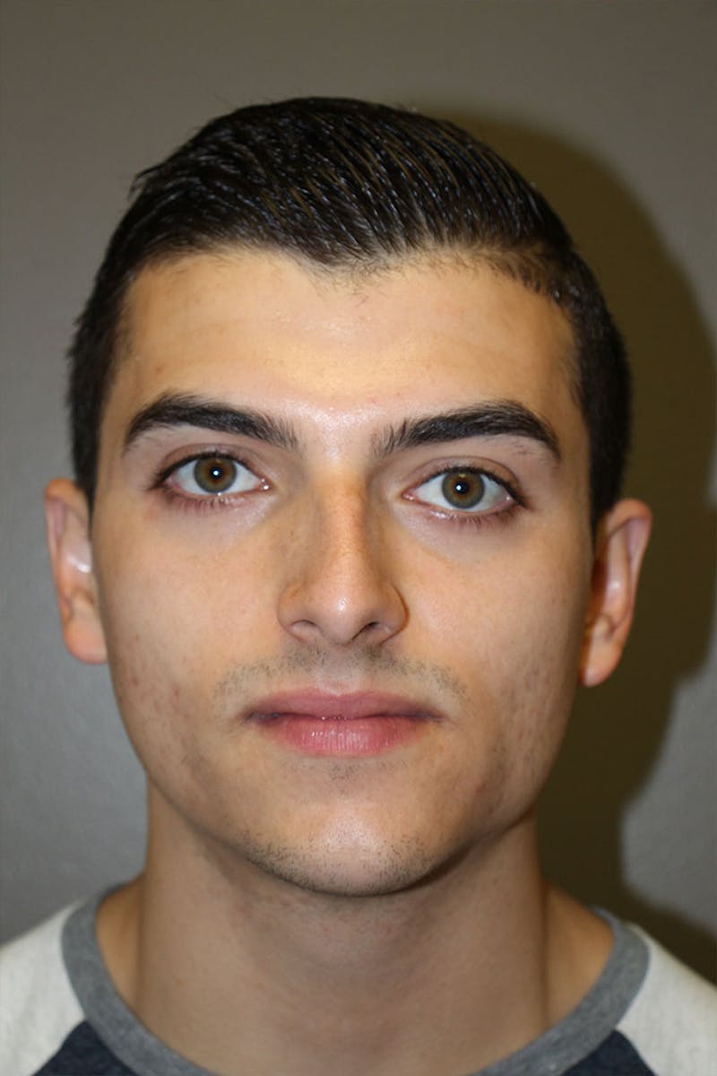 Rhinoplasty Before & After Gallery - Patient 146669556 - Image 3