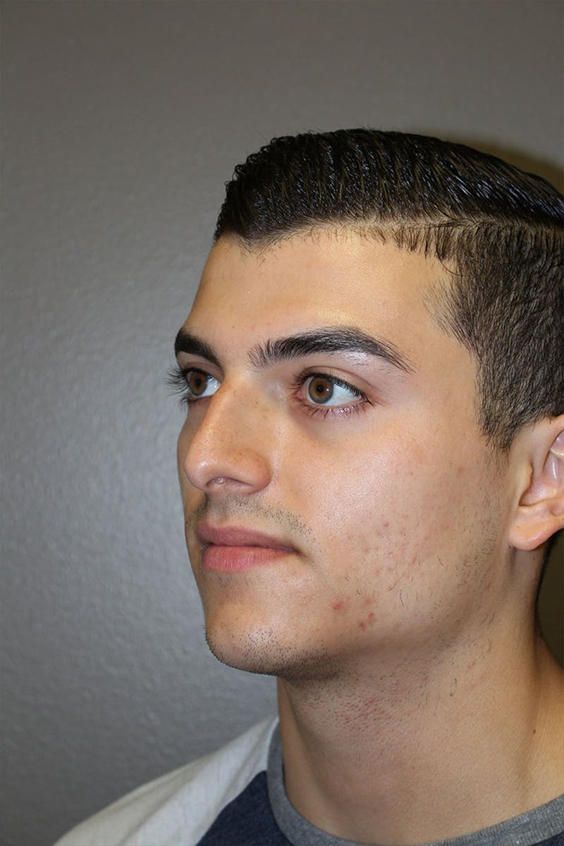 Rhinoplasty Before & After Gallery - Patient 146669556 - Image 5