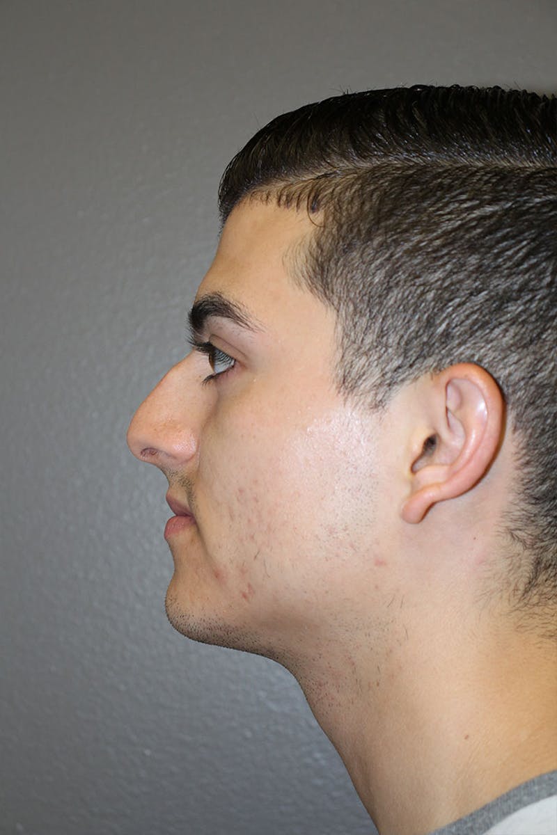Rhinoplasty Before & After Gallery - Patient 146669556 - Image 7