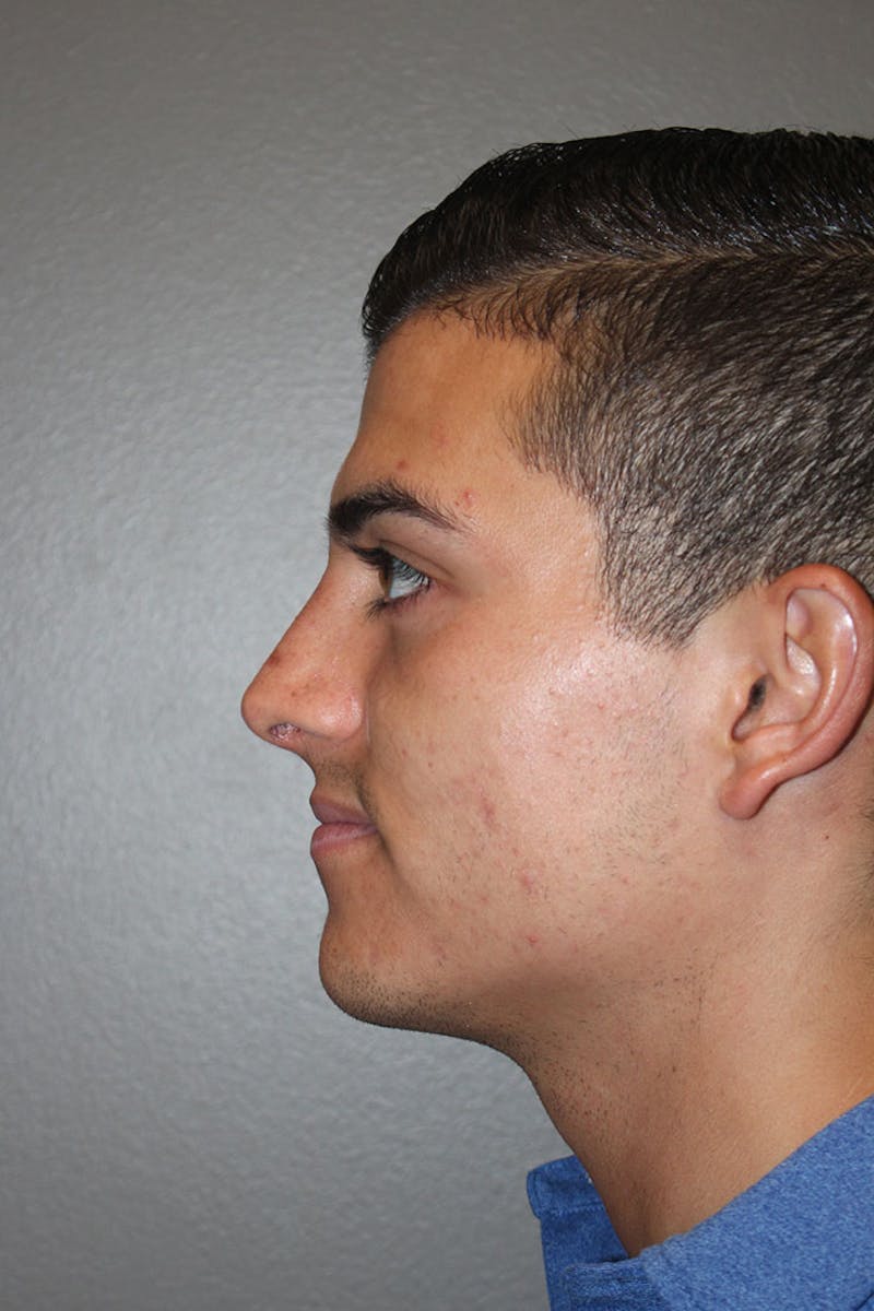 Rhinoplasty Before & After Gallery - Patient 146669556 - Image 8