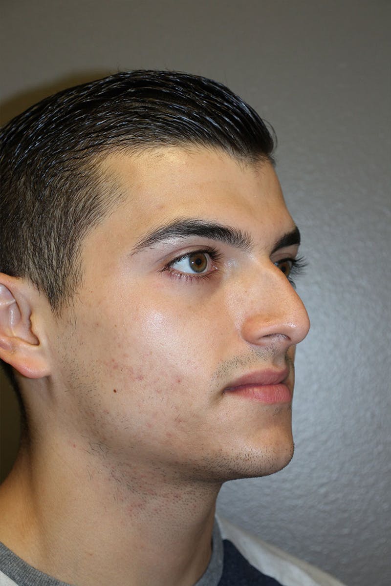 Rhinoplasty Before & After Gallery - Patient 146669556 - Image 9