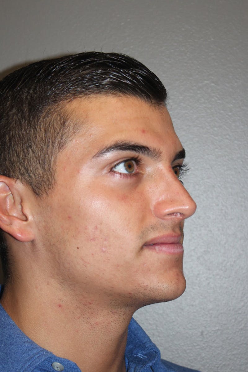 Rhinoplasty Before & After Gallery - Patient 146669556 - Image 10