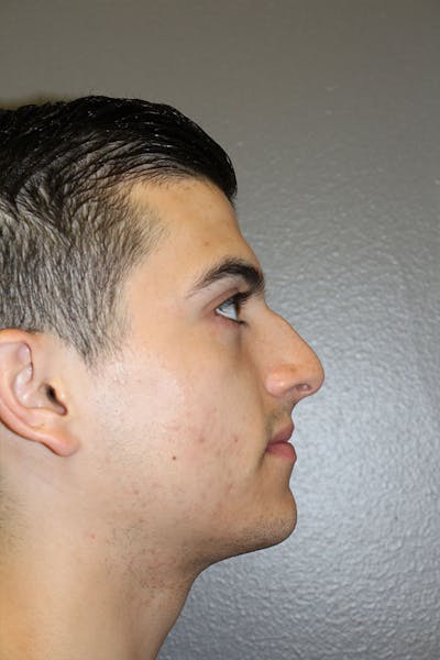 Rhinoplasty Before & After Gallery - Patient 146669556 - Image 1