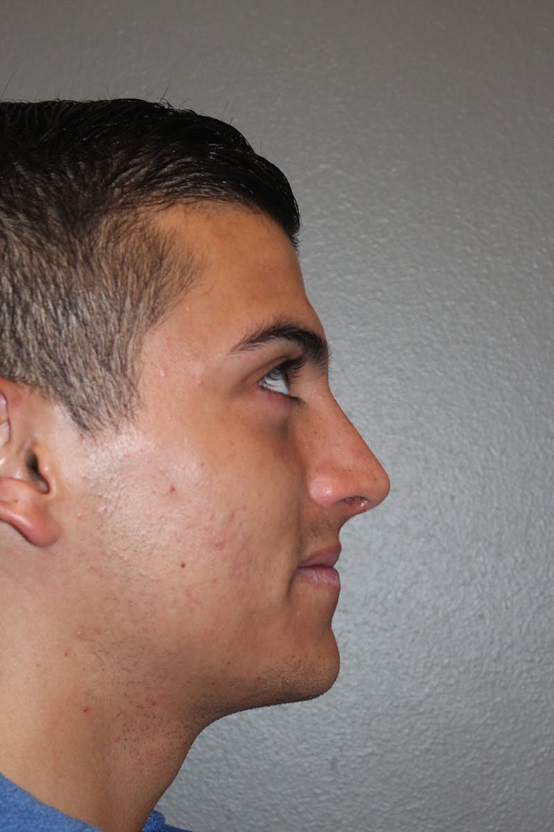 Rhinoplasty Before & After Gallery - Patient 146669556 - Image 2