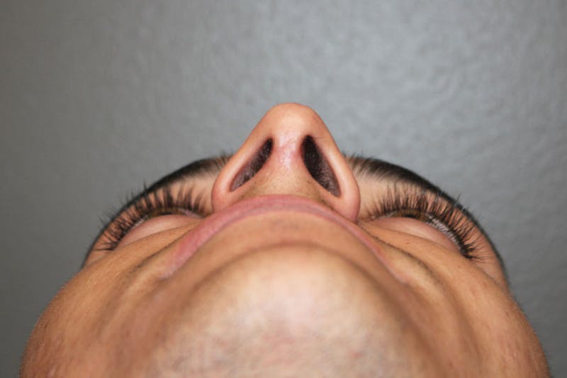 Rhinoplasty Before & After Gallery - Patient 146669556 - Image 12