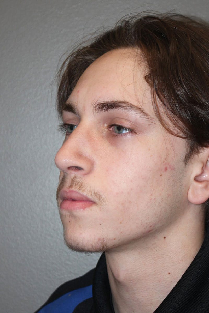 Rhinoplasty Before & After Gallery - Patient 146669555 - Image 6
