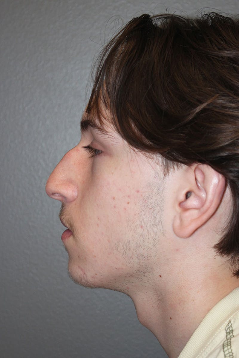 Rhinoplasty Before & After Gallery - Patient 146669555 - Image 7