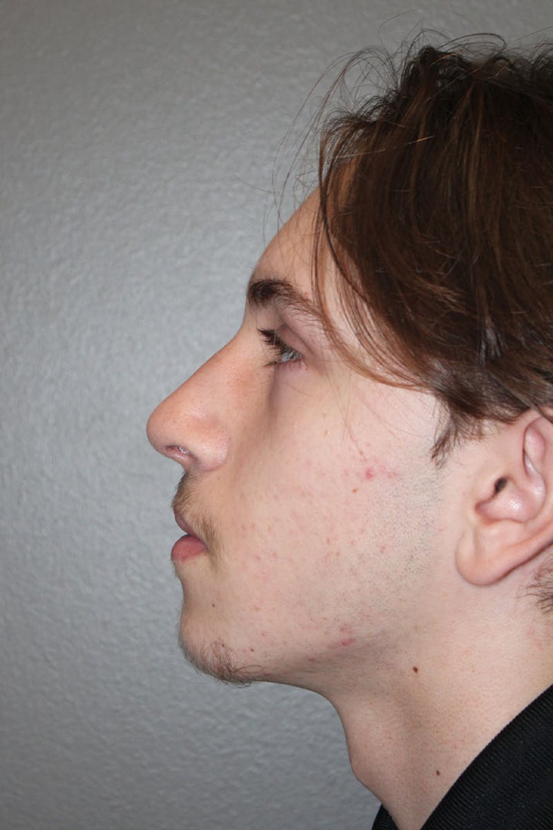 Rhinoplasty Before & After Gallery - Patient 146669555 - Image 8