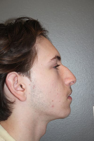 Rhinoplasty Before & After Gallery - Patient 146669555 - Image 1