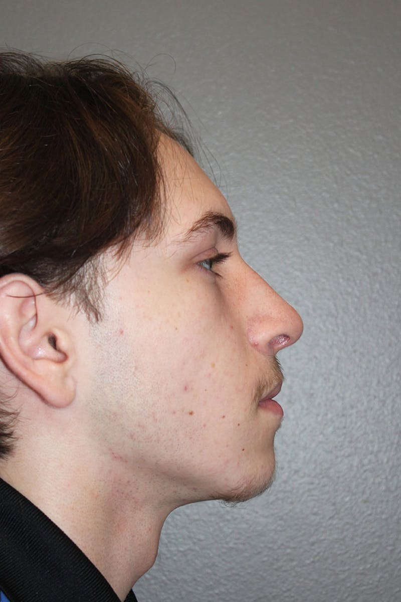 Rhinoplasty Before & After Gallery - Patient 146669555 - Image 2
