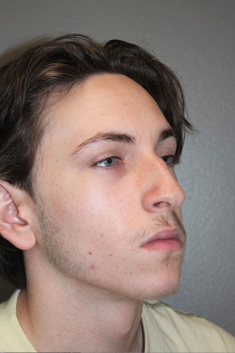 Rhinoplasty Before & After Gallery - Patient 146669555 - Image 9