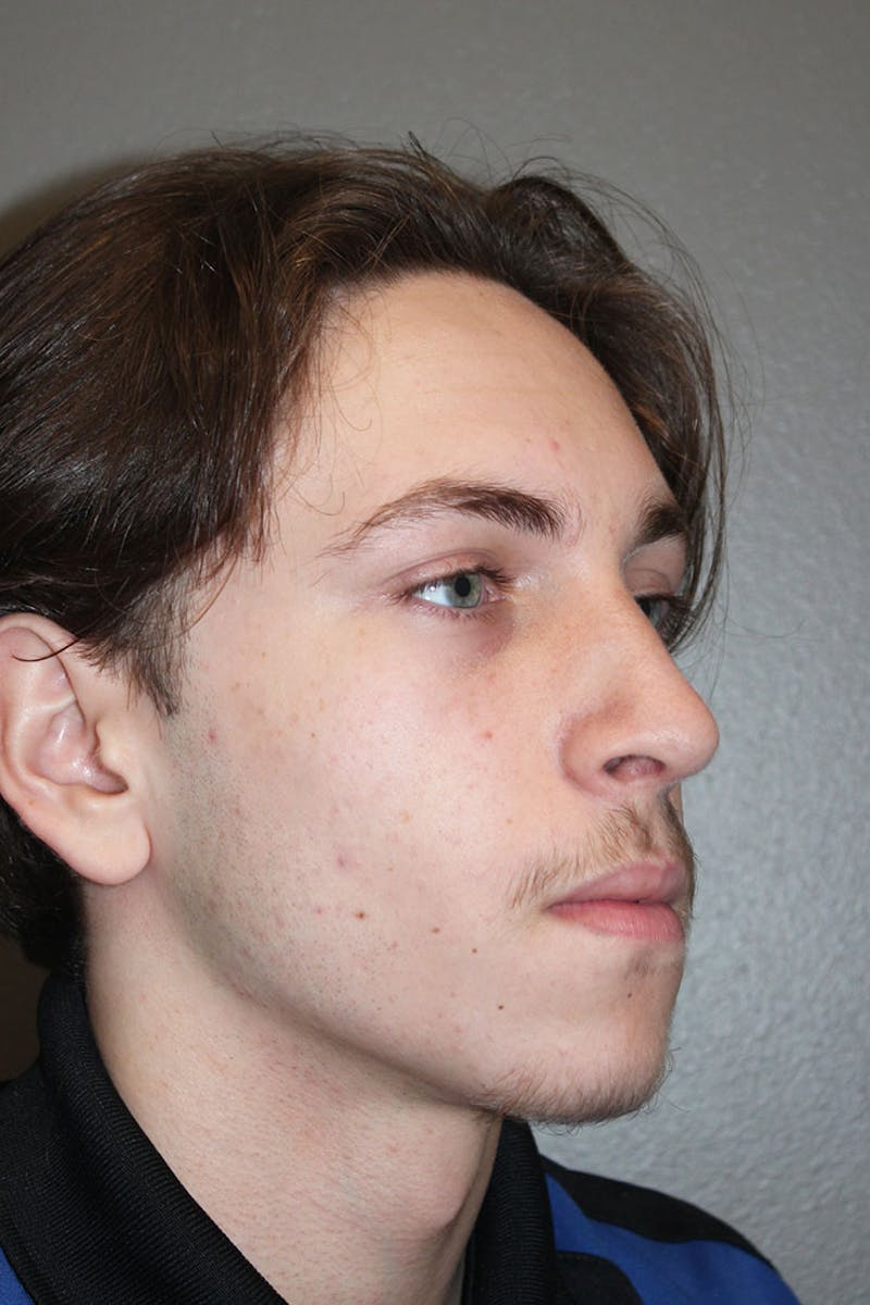 Rhinoplasty Before & After Gallery - Patient 146669555 - Image 10