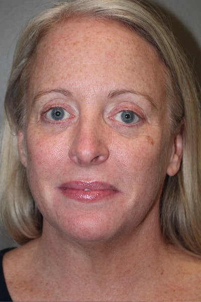 Facelift Before & After Gallery - Patient 174901089 - Image 1