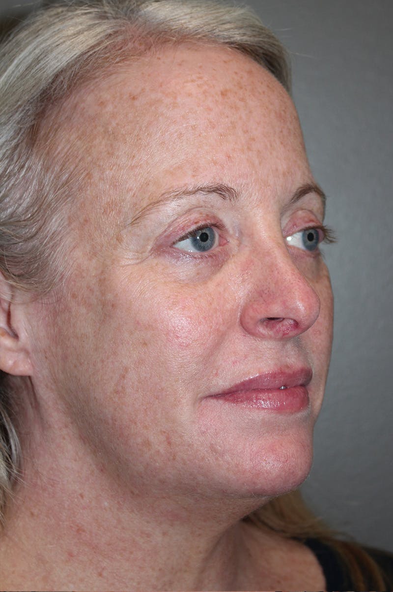 Facelift Before & After Gallery - Patient 174901089 - Image 3
