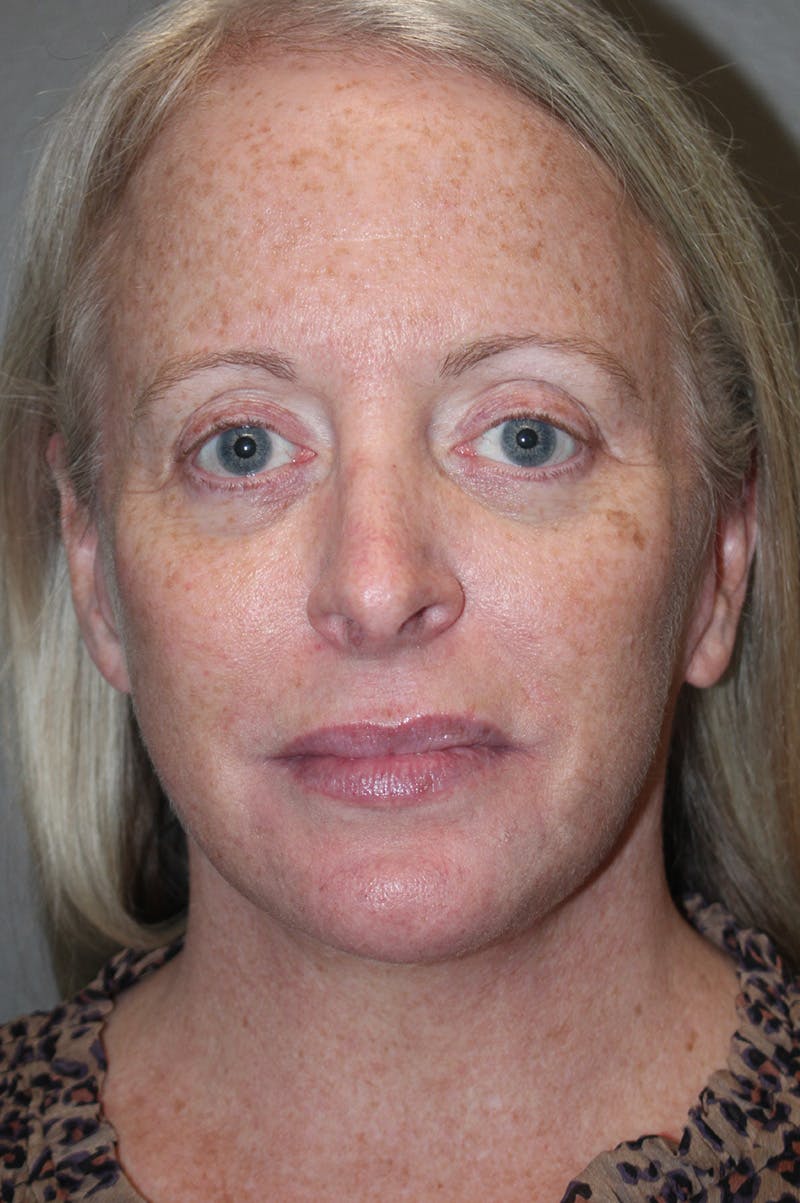 Facelift Before & After Gallery - Patient 174901089 - Image 2