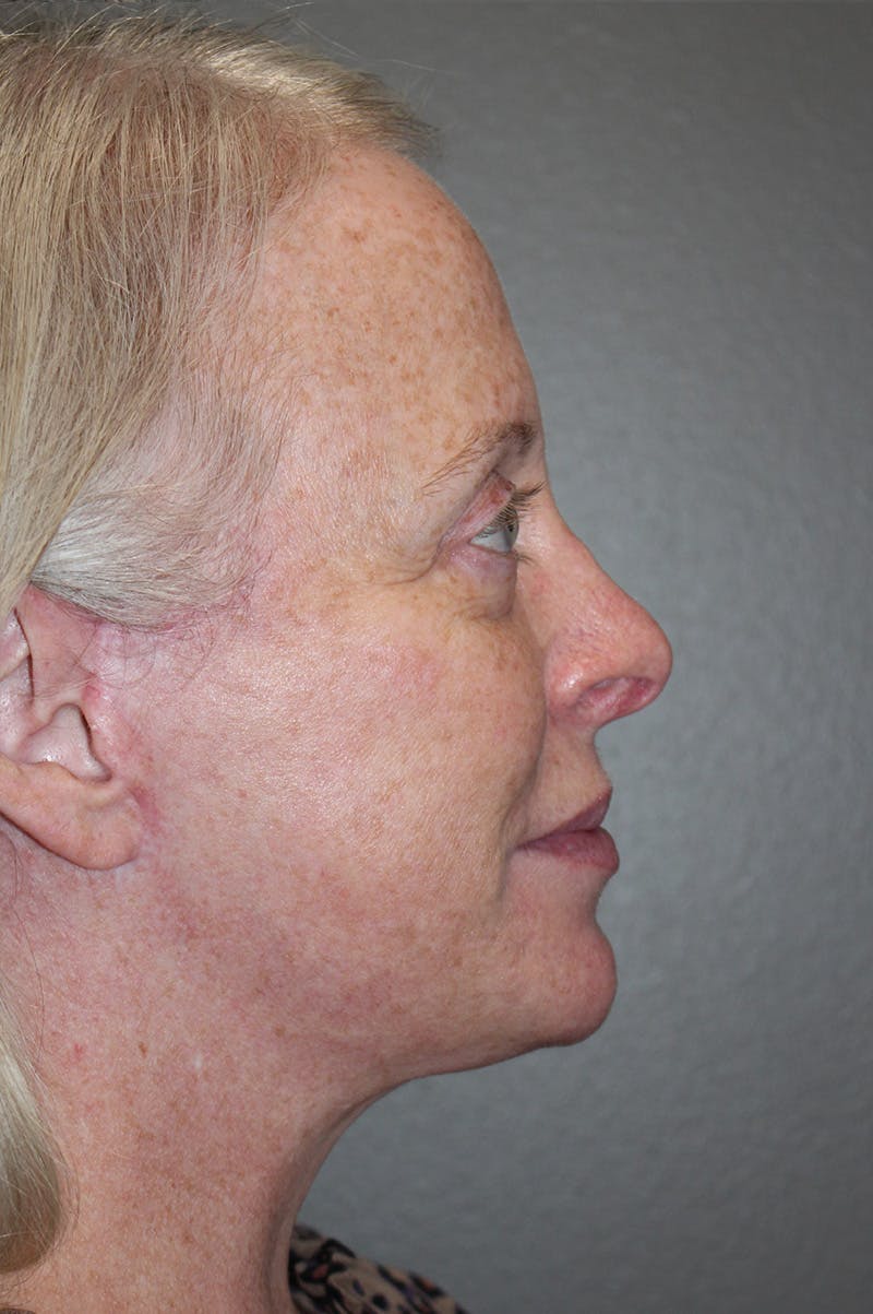 Facelift Before & After Gallery - Patient 174901089 - Image 6