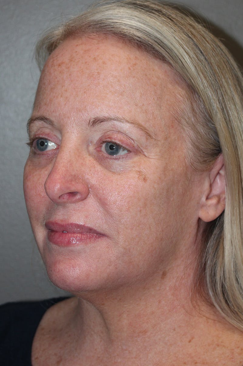 Facelift Before & After Gallery - Patient 174901089 - Image 7