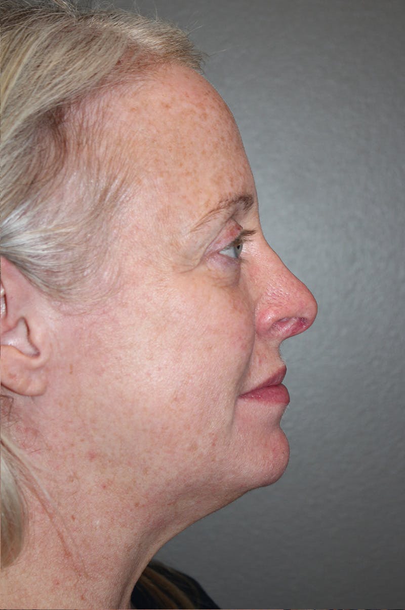 Facelift Before & After Gallery - Patient 174901089 - Image 5