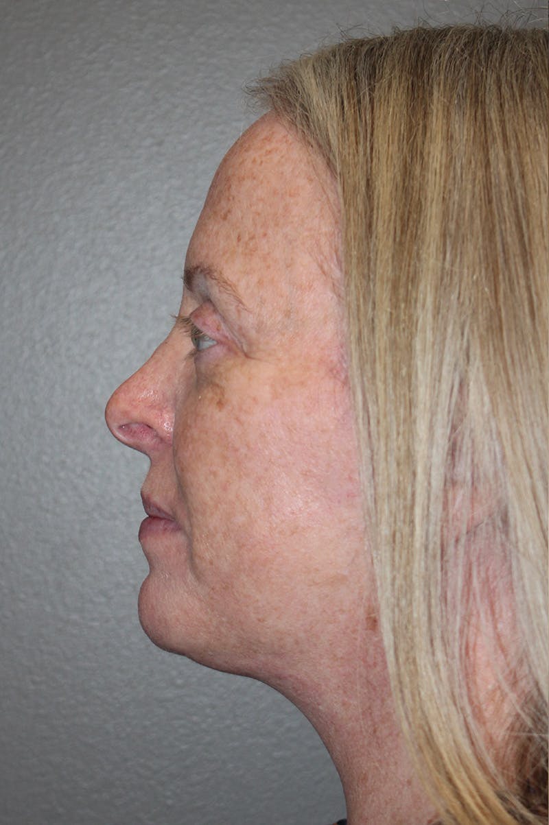 Facelift Before & After Gallery - Patient 174901089 - Image 10