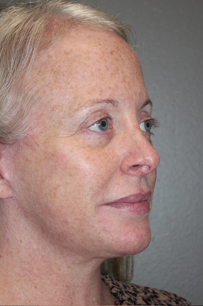 Facelift Before & After Gallery - Patient 174901089 - Image 4