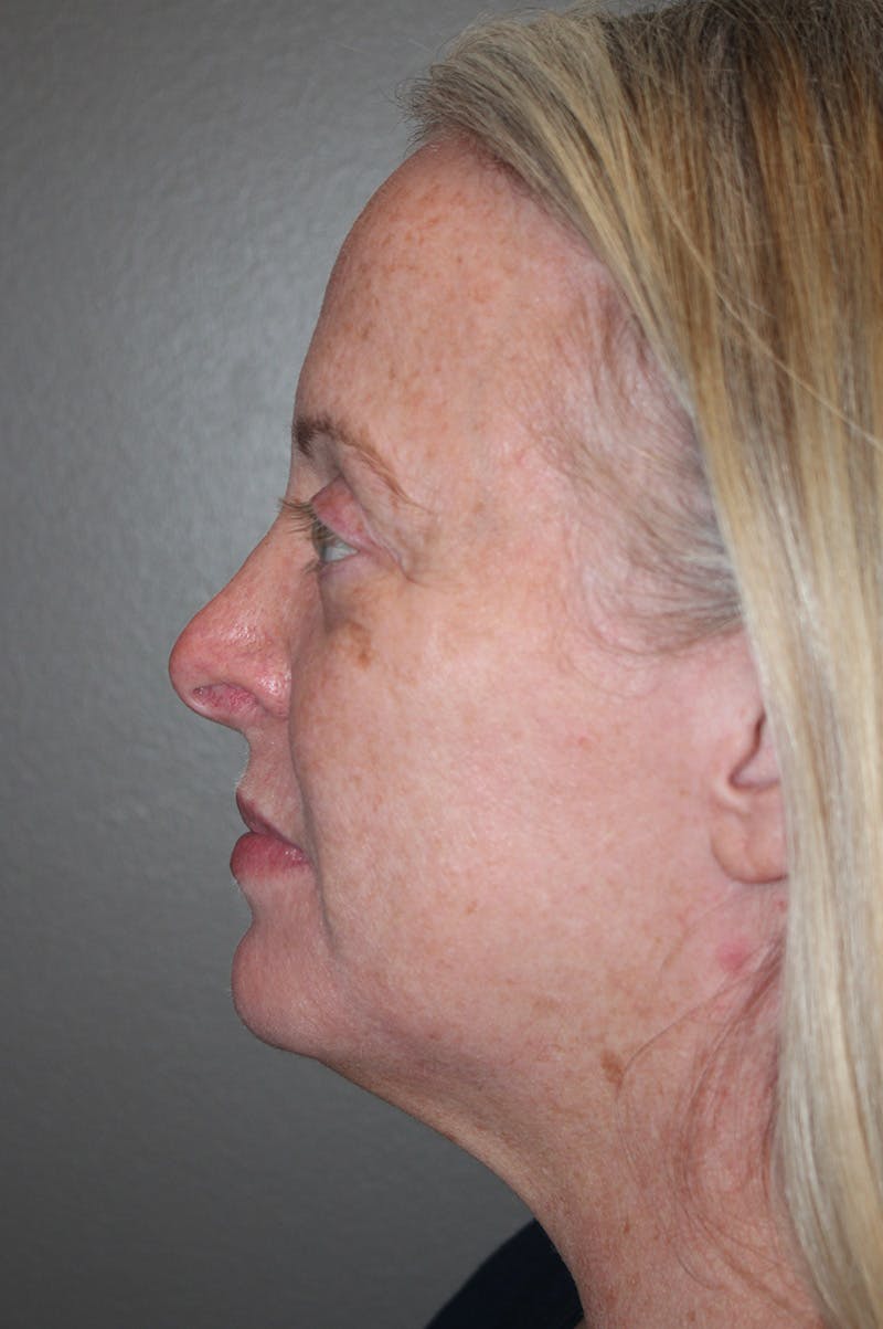 Facelift Before & After Gallery - Patient 174901089 - Image 9
