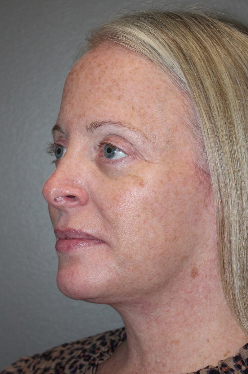 Facelift Before & After Gallery - Patient 174901089 - Image 8