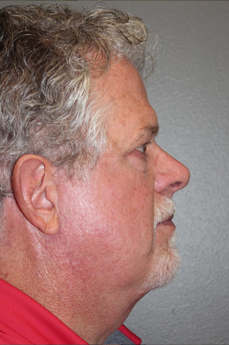 Facelift Before & After Gallery - Patient 174901097 - Image 6