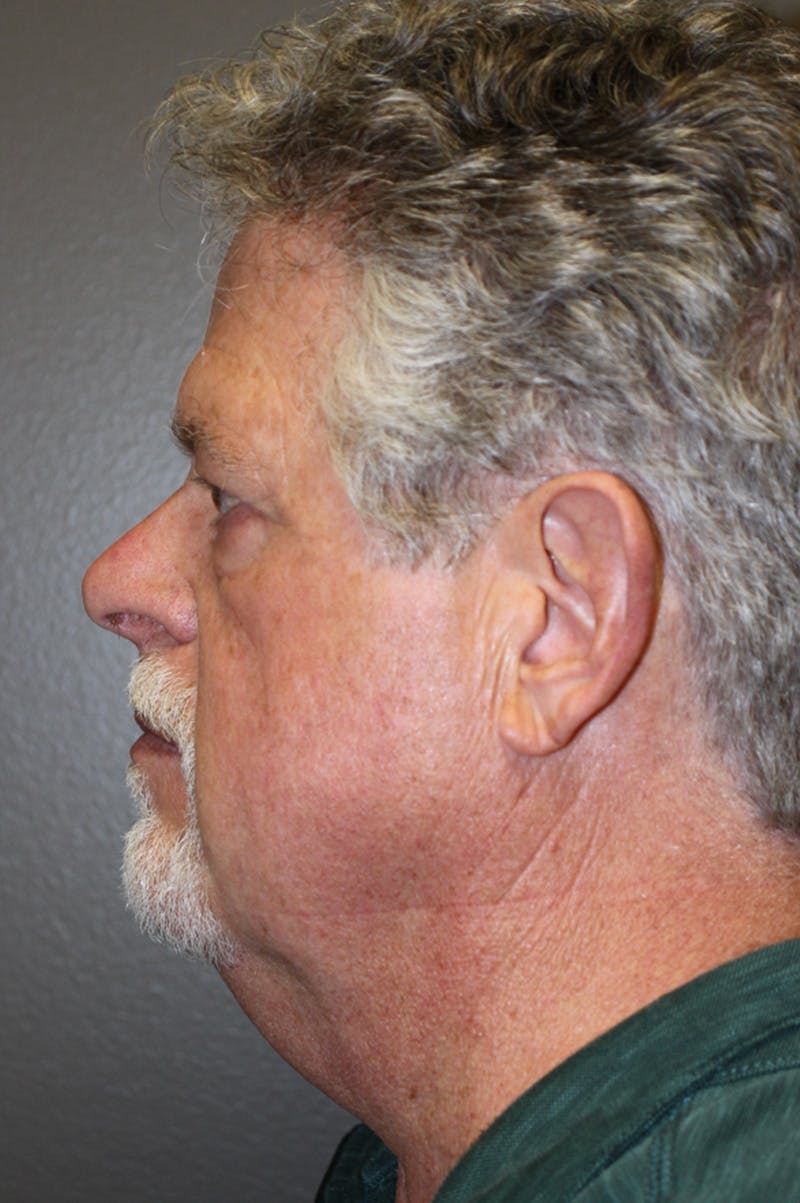 Facelift Before & After Gallery - Patient 174901097 - Image 7
