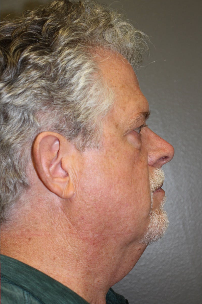 Facelift Before & After Gallery - Patient 174901097 - Image 5