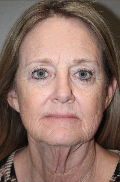 Facelift Before & After Gallery - Patient 174901088 - Image 1