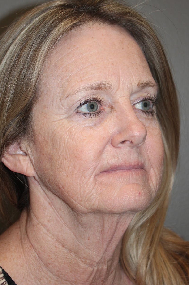 Facelift Before & After Gallery - Patient 174901088 - Image 3