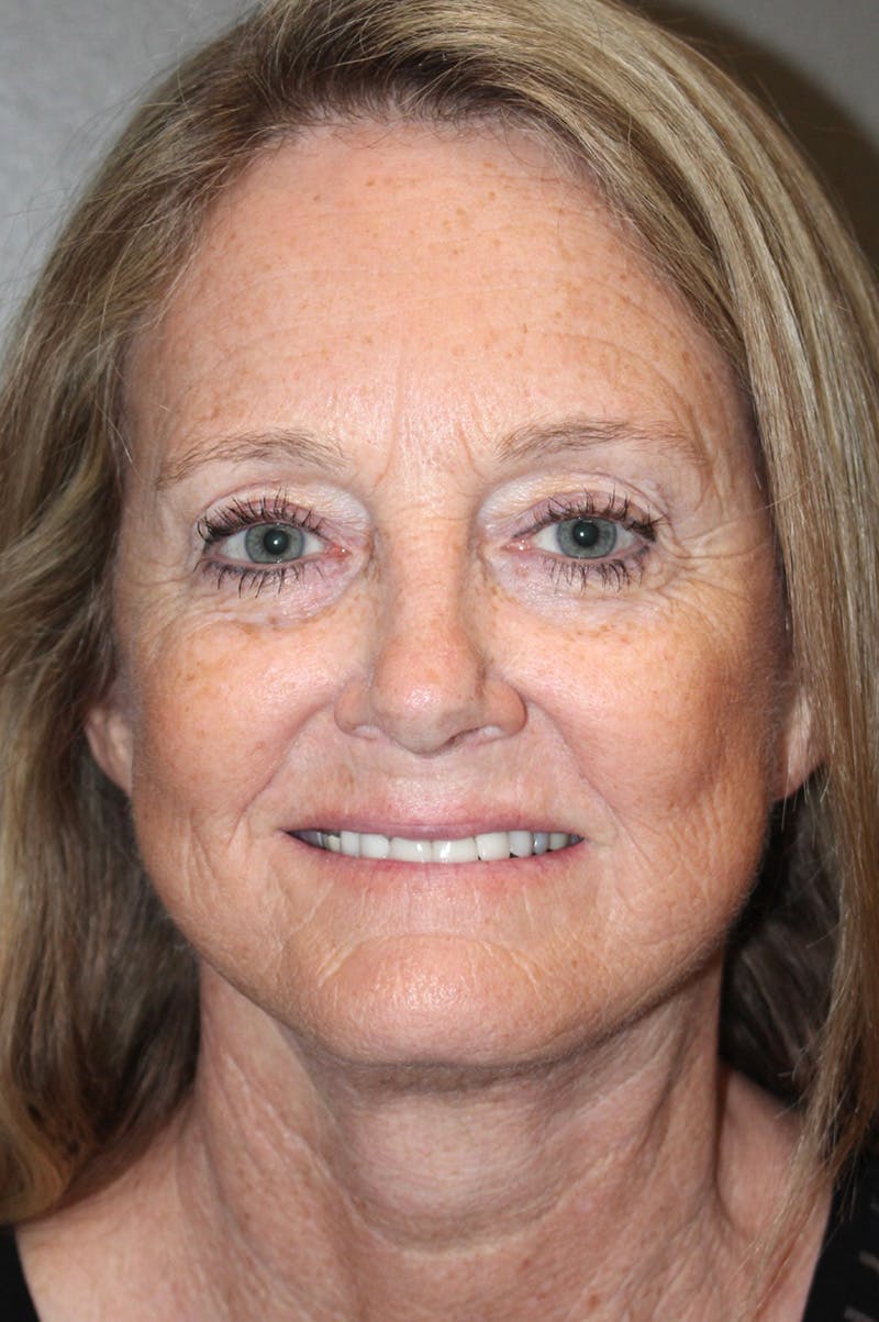 Facelift Before & After Gallery - Patient 174901088 - Image 2