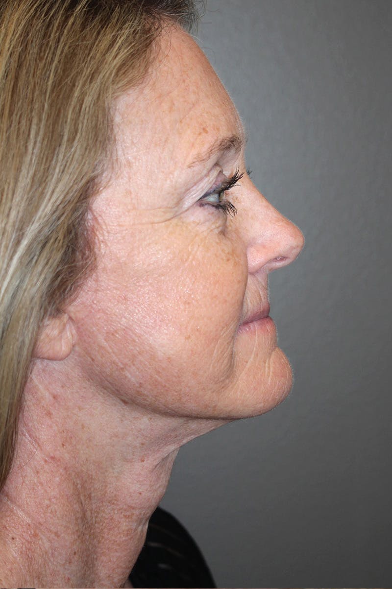 Facelift Before & After Gallery - Patient 174901088 - Image 6