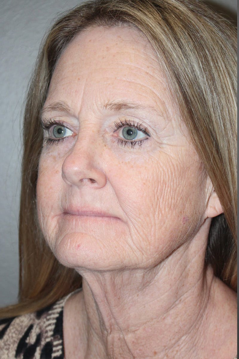 Facelift Before & After Gallery - Patient 174901088 - Image 7