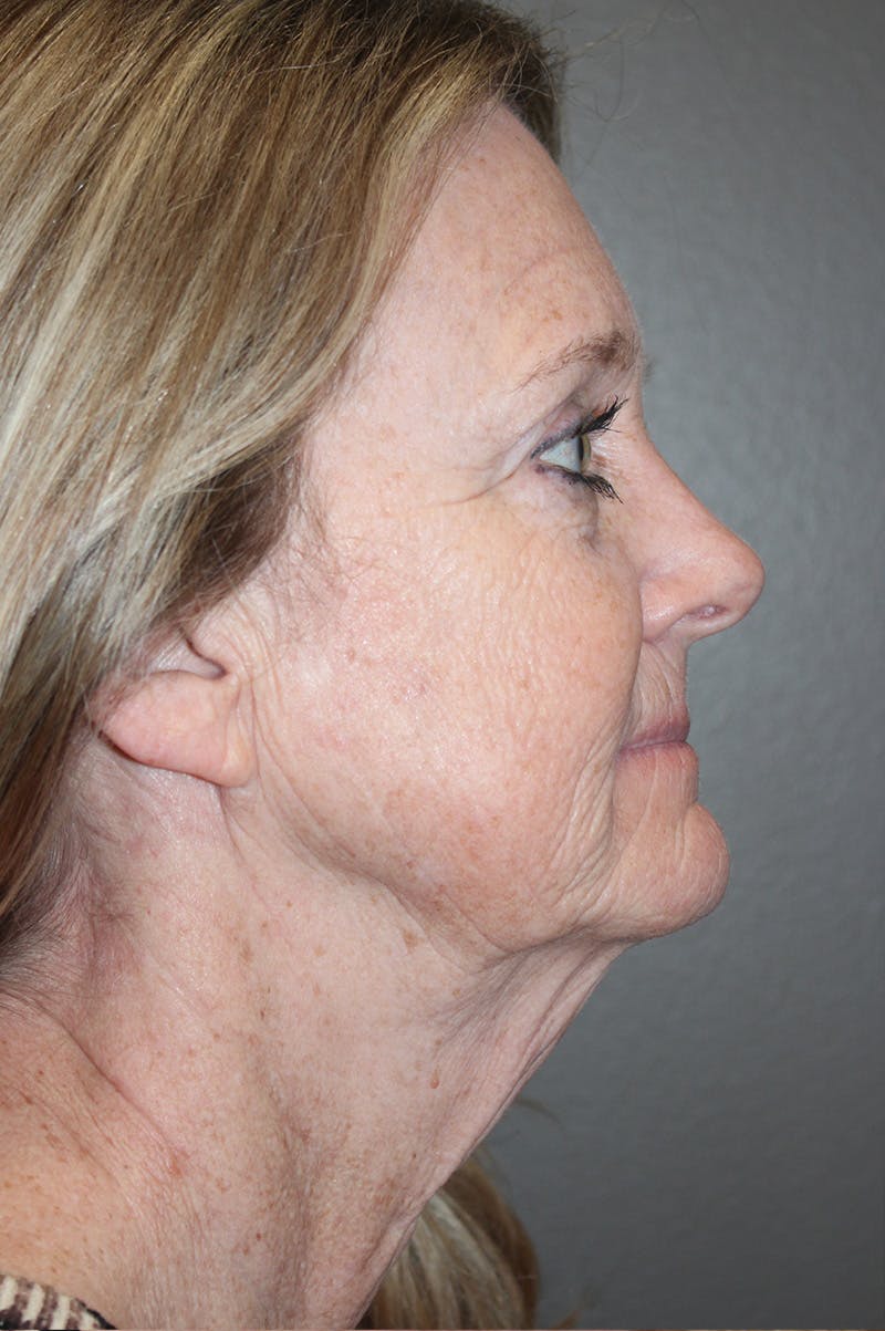 Facelift Before & After Gallery - Patient 174901088 - Image 5