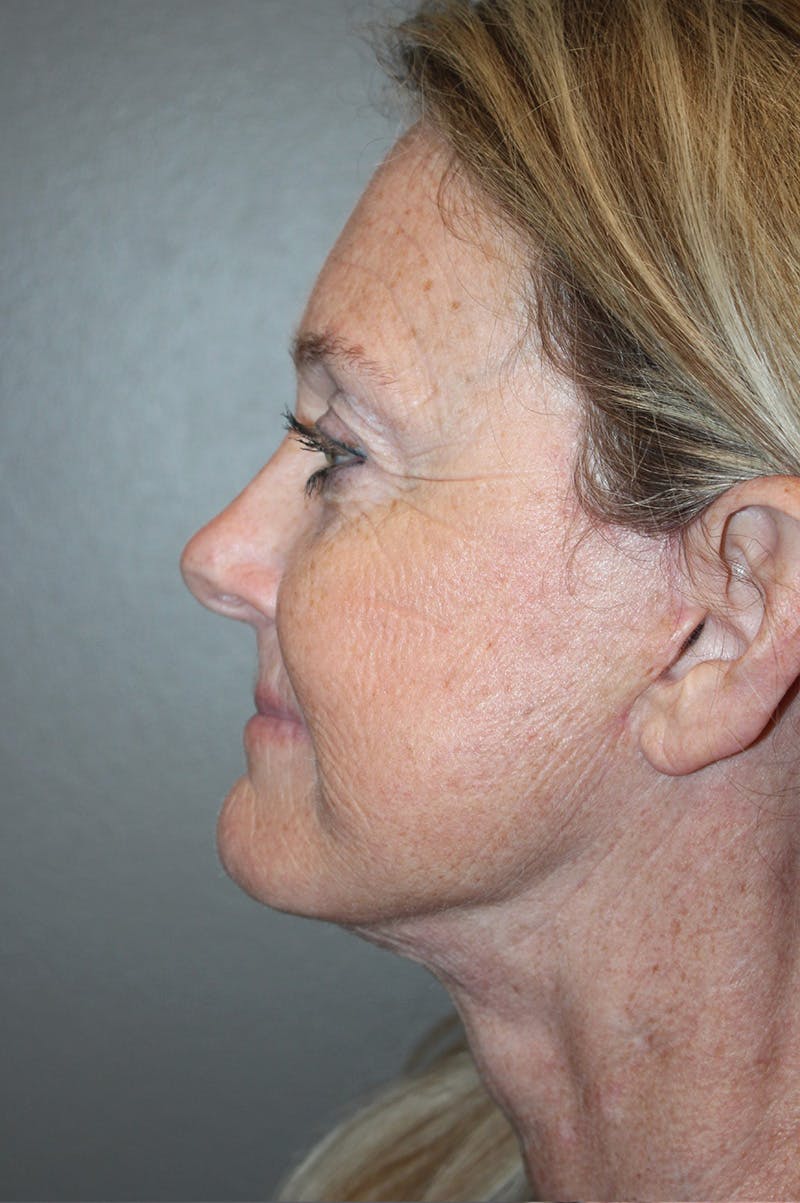 Facelift Before & After Gallery - Patient 174901088 - Image 10
